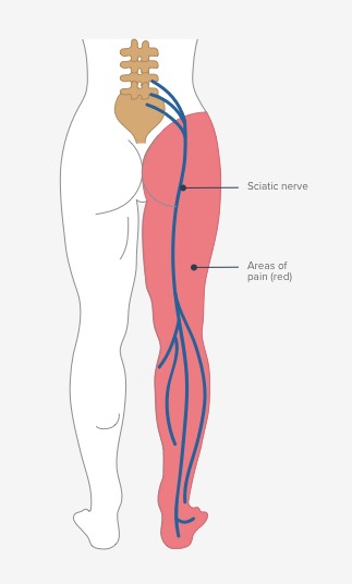 Types of Sciatic Nerve Pain
